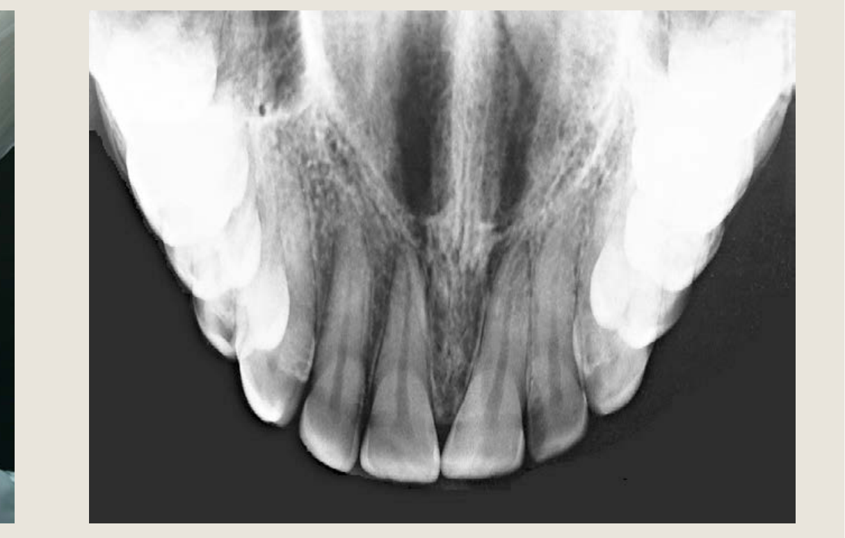 Anterior Maxilla Occlusograph