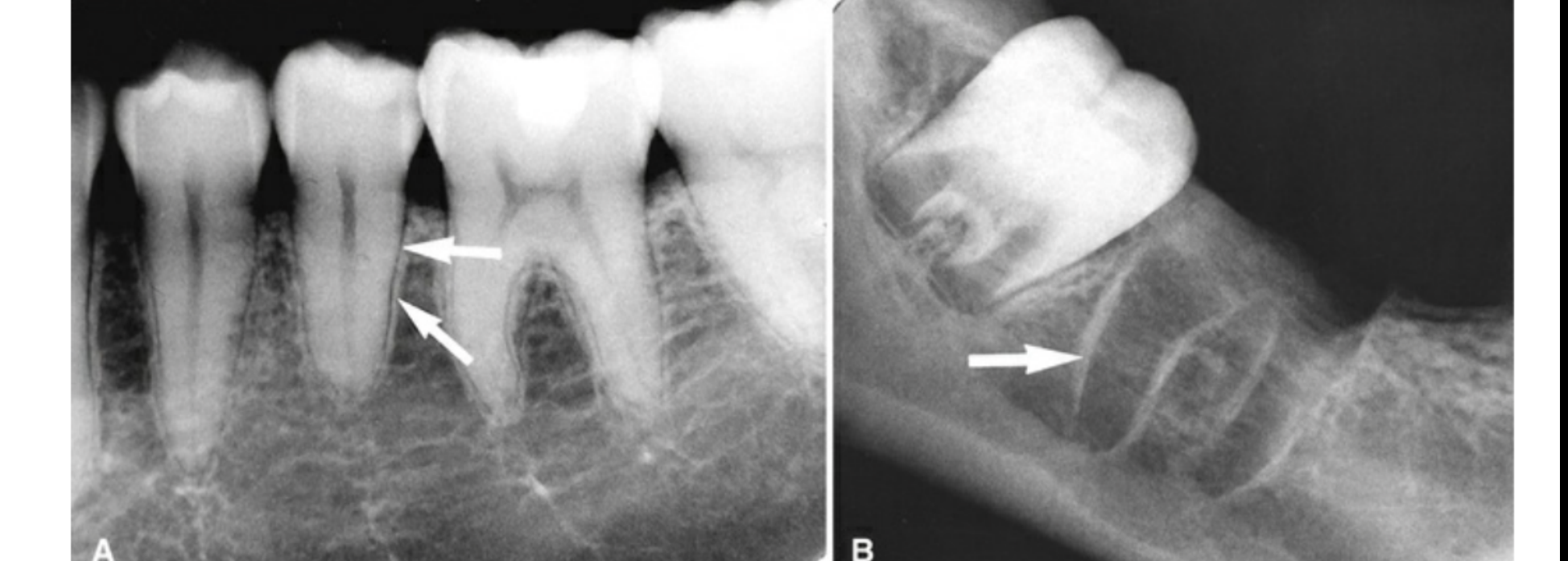 FIG. 12.9 The lamina dura (arrows) appears as a thin opaque layer of bone around teeth (A) and around a recent extraction socket (B).