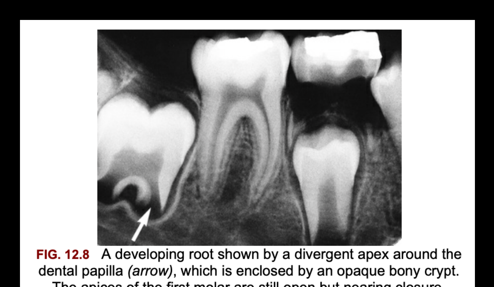FIG. 12.8 A developing root shown by a divergent apex around the dental papilla (arrow), which is enclosed by an opaque bony crypt. The apices of the first molar are still open but nearing closure.