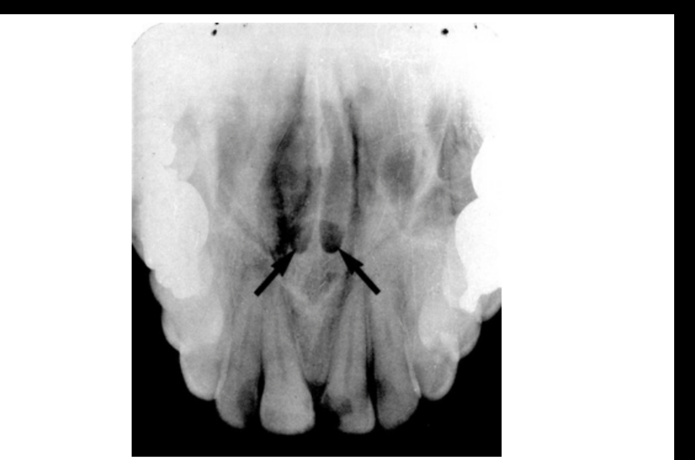 FIG. 12.30 The superior foramina of the nasopalatine canal (arrows) appear just lateral to the nasal septum and posterior to the anterior nasal spine.