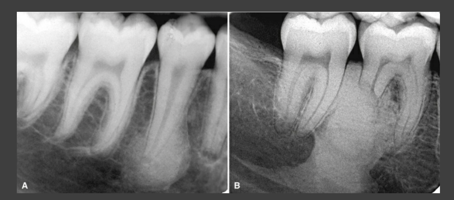 A and B