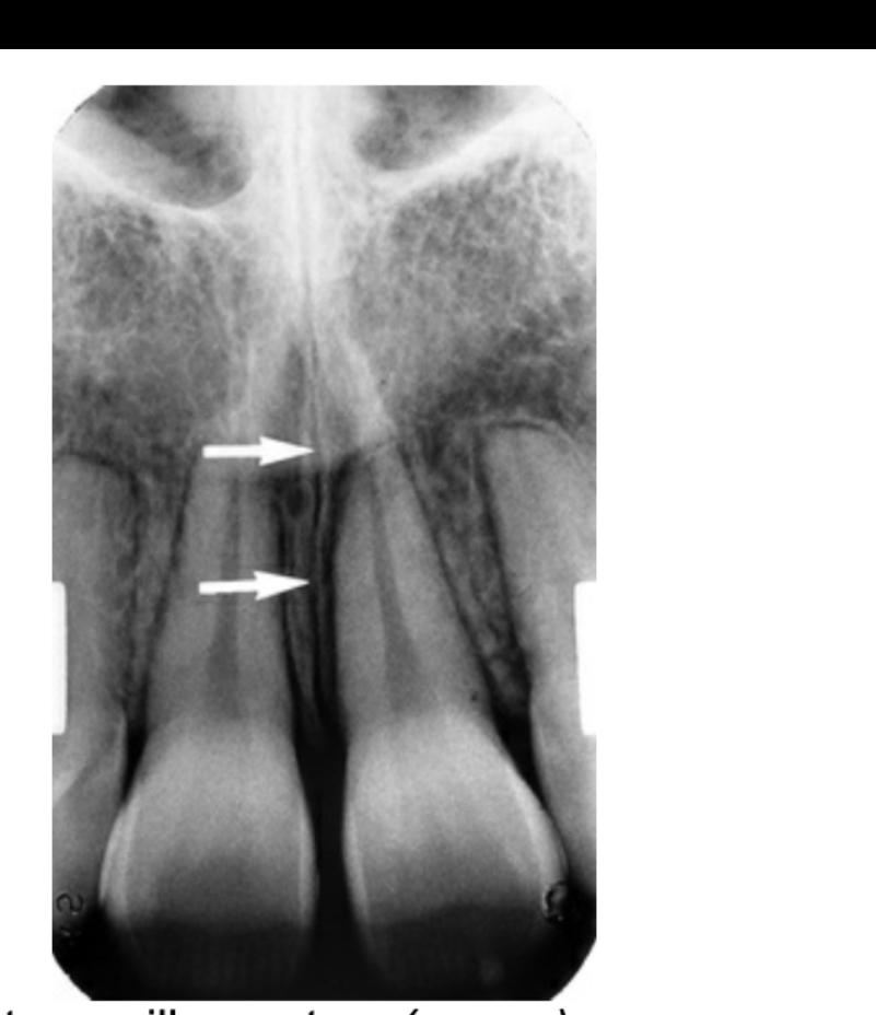 FIG. 12.19 The intermaxillary suture (arrows) appears as a curved radiolucency in the midline of the maxilla.