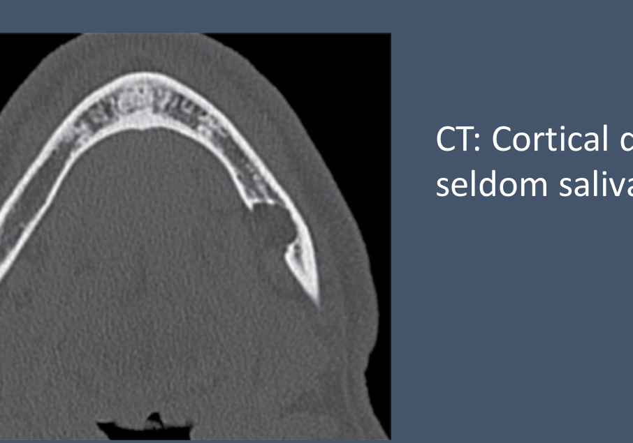 CT: Cortical depression (often fat-filled, seldom salivary gland)