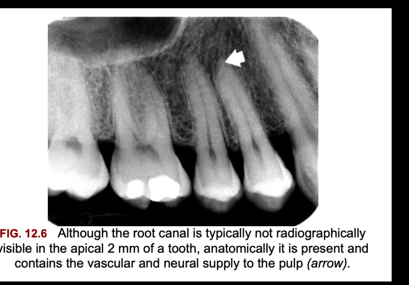 FIG. 12.6 Although the root canal is typically not radiographically visible in the apical 2 mm of a tooth, anatomically it is present and contains the vascular and neural supply to the pulp (arrow).