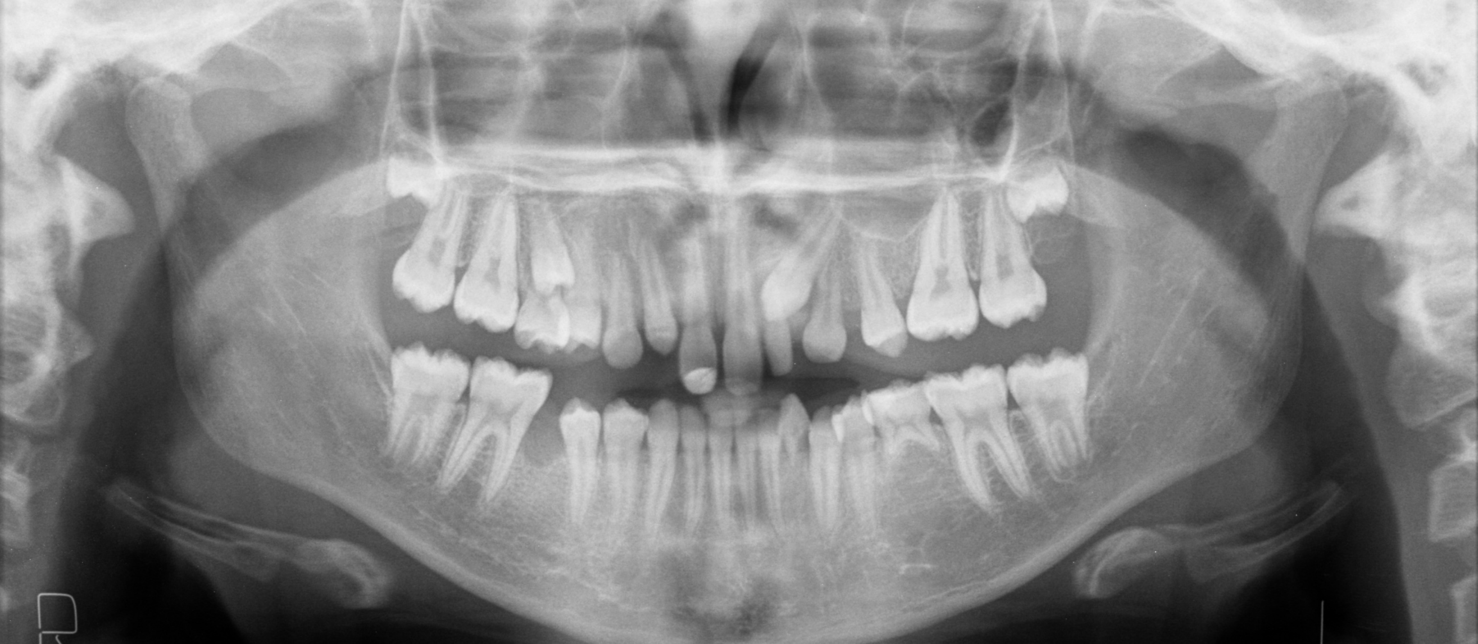 *Find retained deciduous teeth*