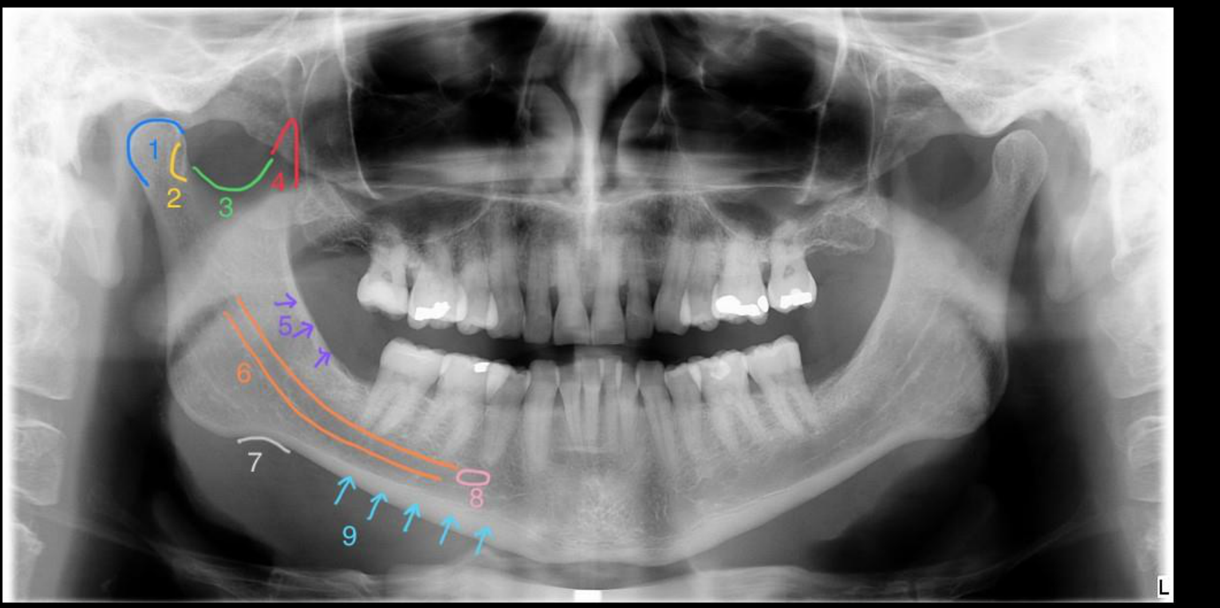 Case 4 – Mandibular Anatomy