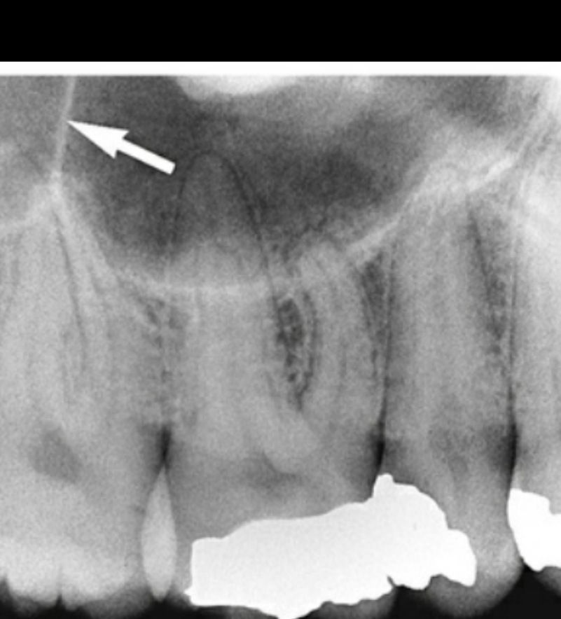 FIG. 12.40 Neurovascular canals (arrows) in the lateral wall of the maxillary sinus. Such vascular canals, although typically less prominent, are commonly seen in the walls of the normal maxillary sinus.