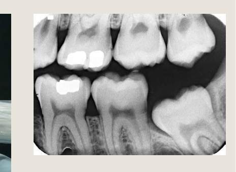 "LEFT POSTERIOR BITEWING" Radiograph