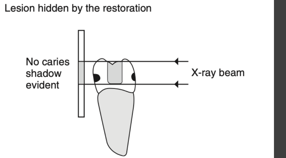 B Buccal and lingual lesions hidden by the restoration