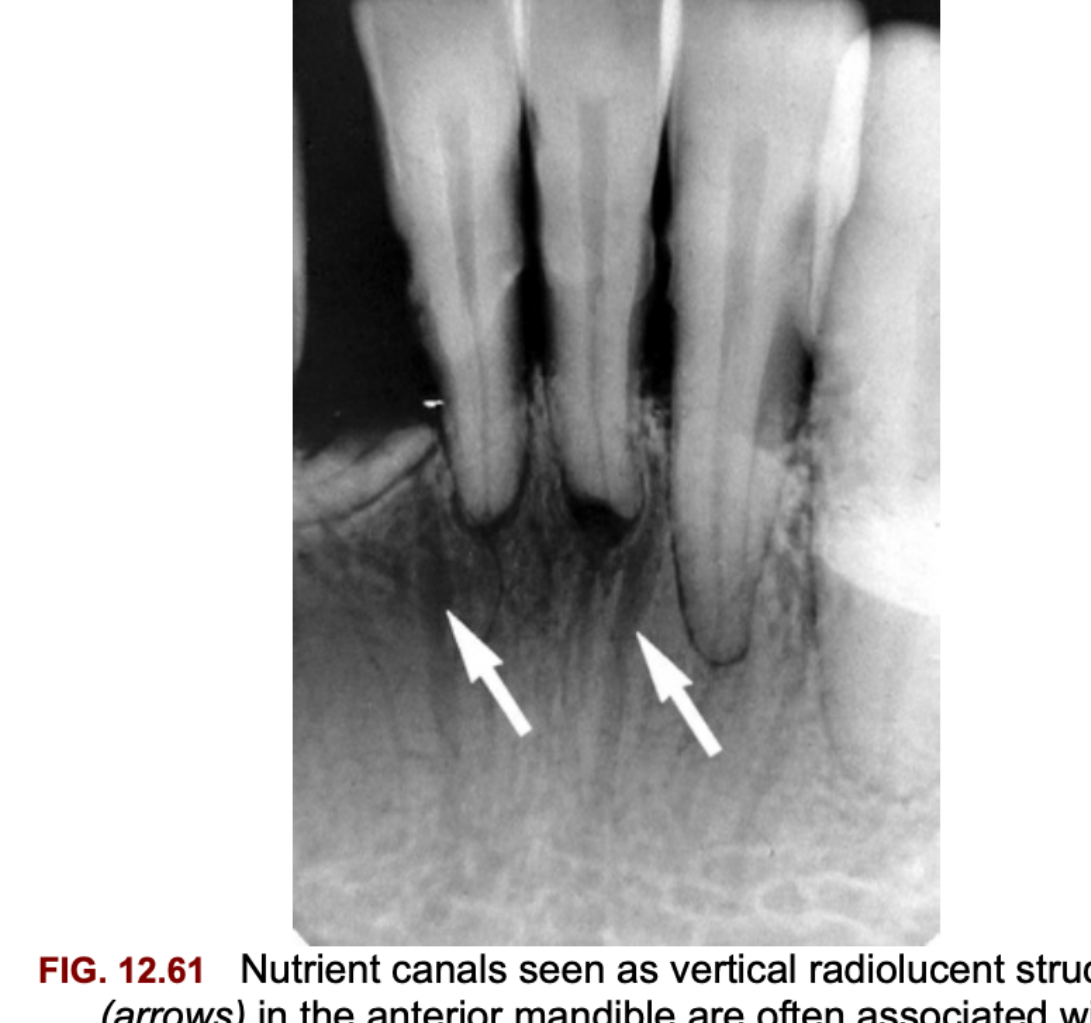 FIG. 12.61 Nutrient canals seen as vertical radiolucent structures (arrows) in the anterior mandible are often associated with periodontal disease as in this patient.