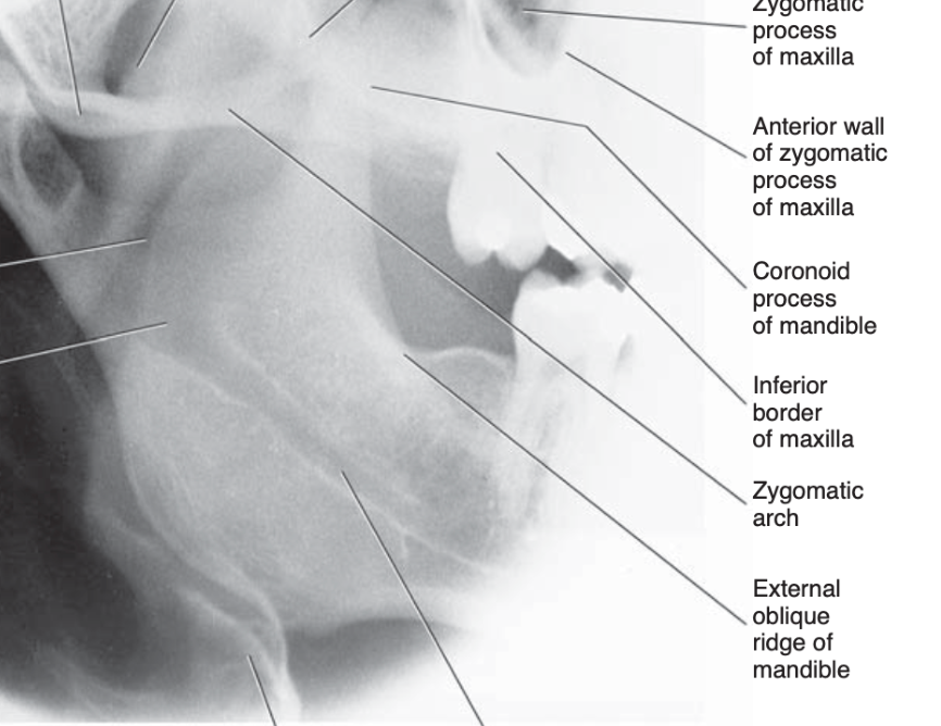 FIG. 12-8 Anatomic landmarks identified in the oblique lateral projection of the mandibular ramus.