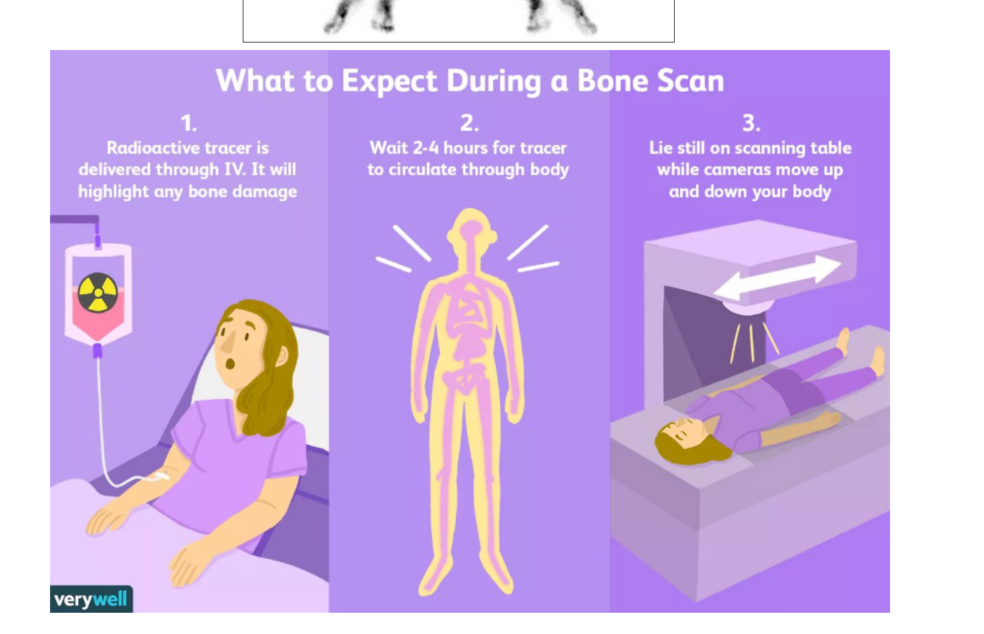 What to Expect During a Bone Scan