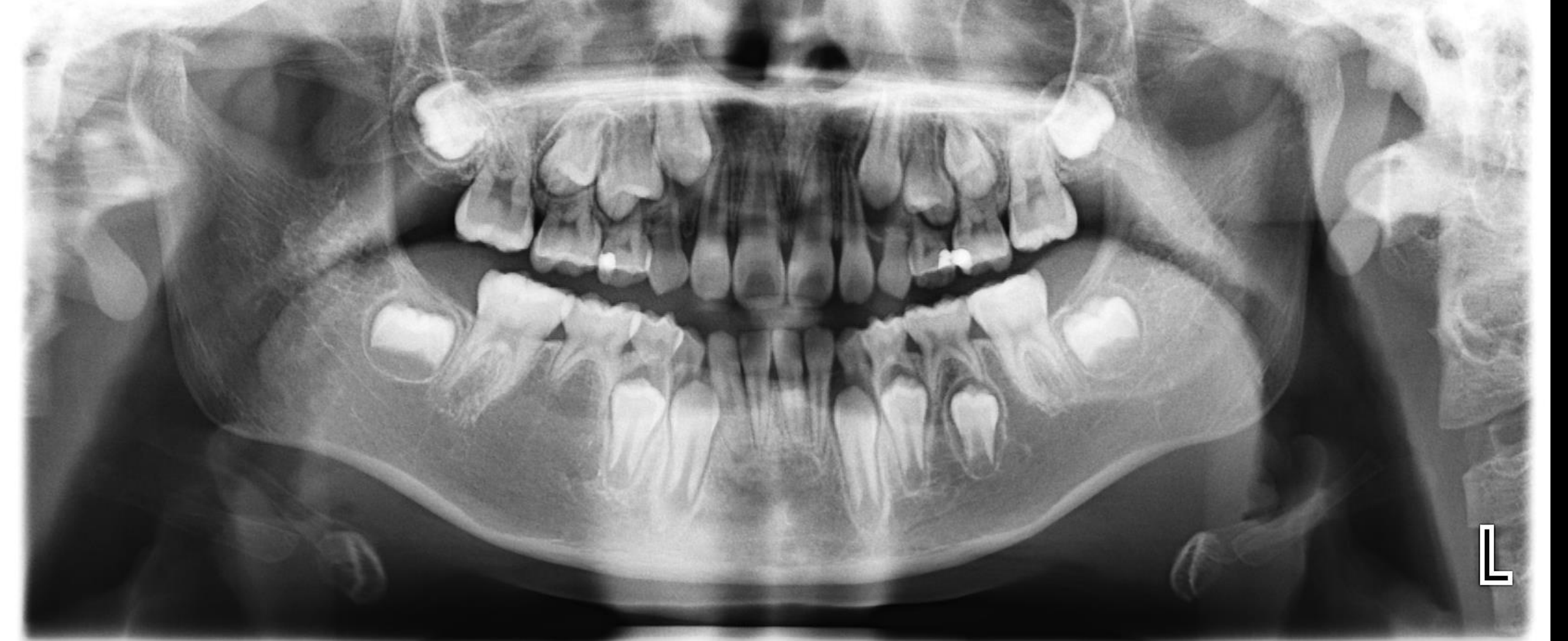 Case 2 - Identify the Teeth using FDI numbers