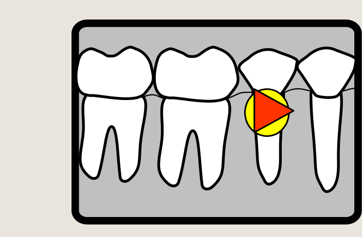 Right lower / mandibular periapical (paralleling technique)