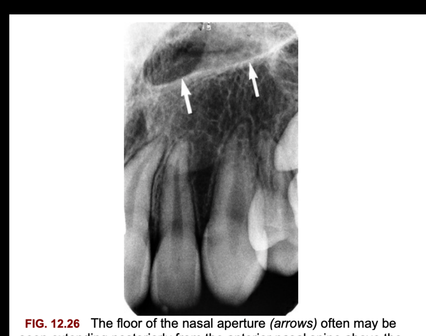 FIG. 12.26 The floor of the nasal aperture (arrows) often may be seen extending posteriorly from the anterior nasal spine above the maxillary lateral incisor and canine.