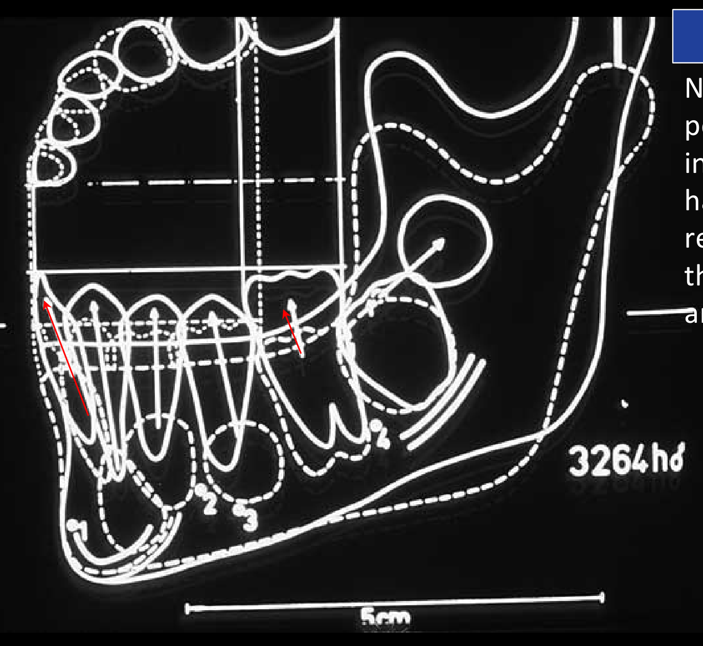 Normal Pattern: No change in antero-posterior position of incisors. Permanent molar has shifted forward relative to the position of the primary molar, so that arch length is diminished.