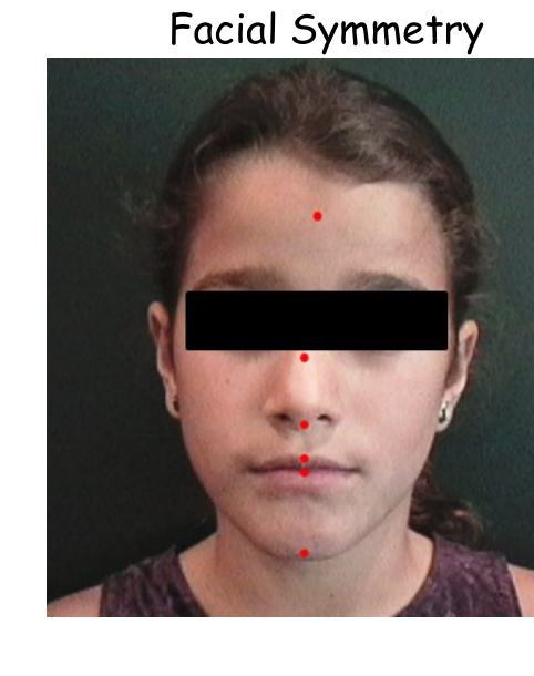 Facial Symmetry — the five midline landmarks marked as red dots