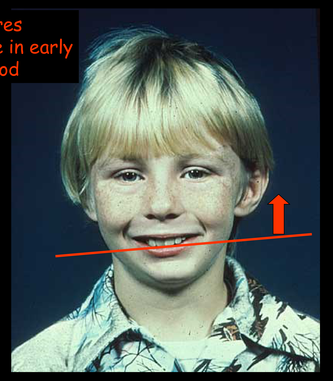 Fractures Condyle in early childhood
