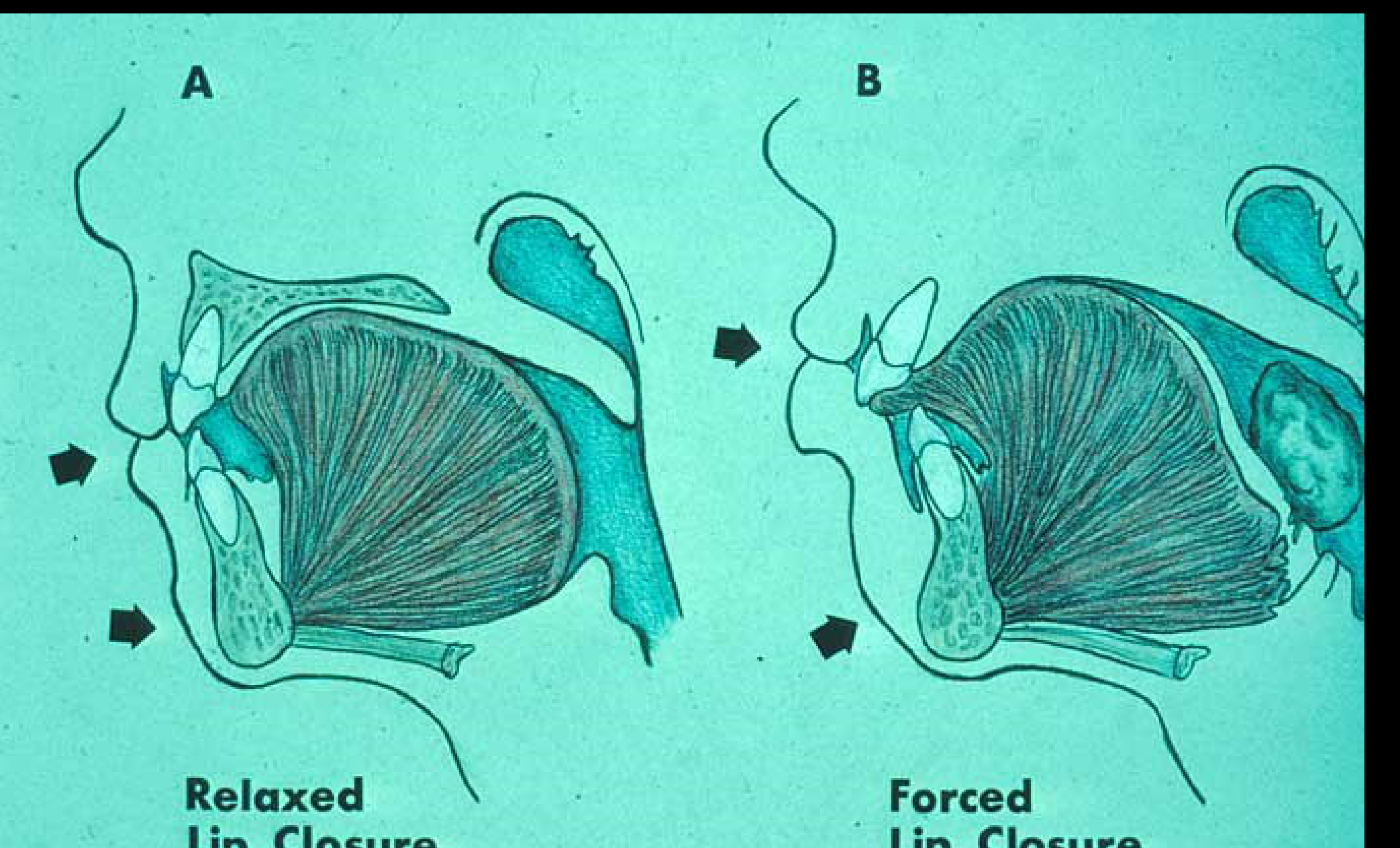 A Relaxed Lip Closure B Forced Lip Closure
