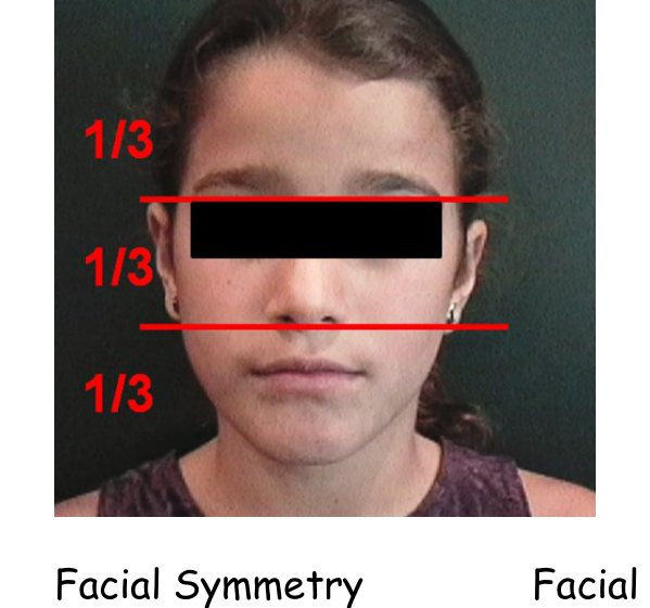 Facial Thirds