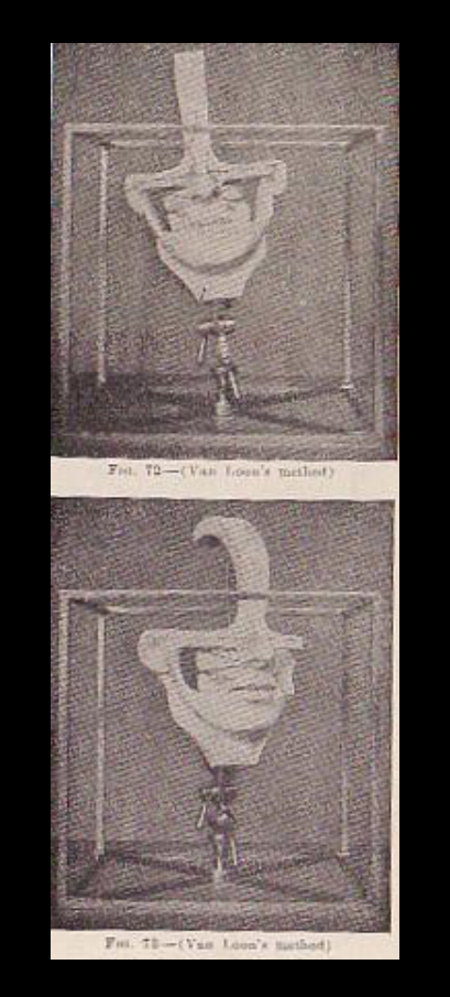 Fig. 72—(Van Loon's method)