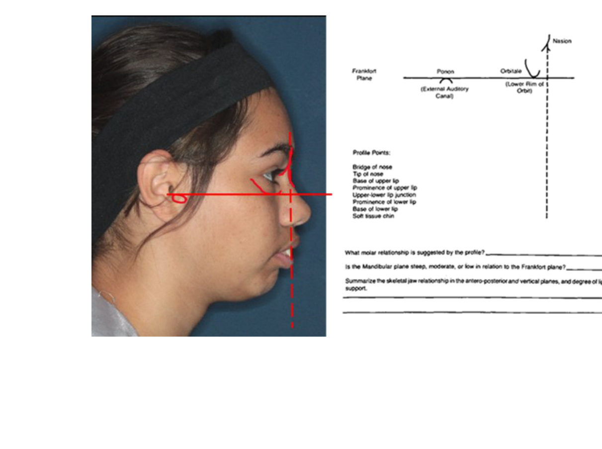 Worksheet — Frankfort horizontal drawn from the tragus on a real profile, alongside the FH diagram and the profile points list