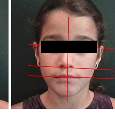 Facial Planes Cant