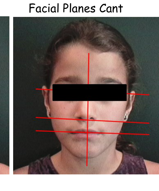 Facial Planes Cant — vertical midline plus interpupillary, alar base and commissural lines drawn on one face