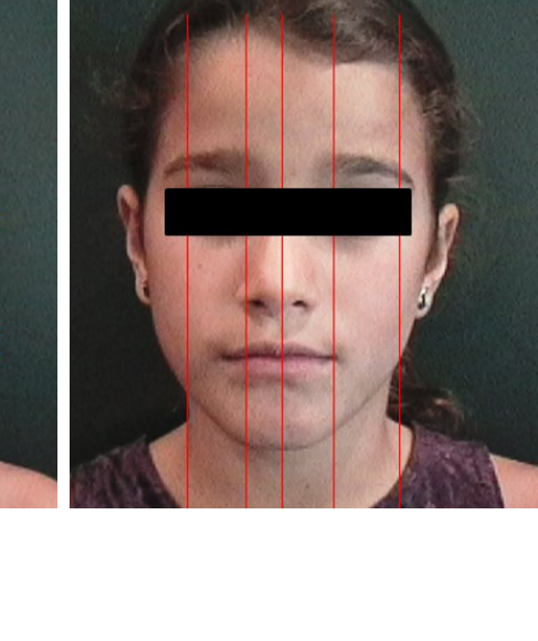 Facial Fifths