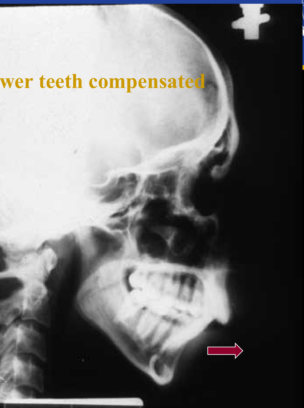 Lower teeth compensated