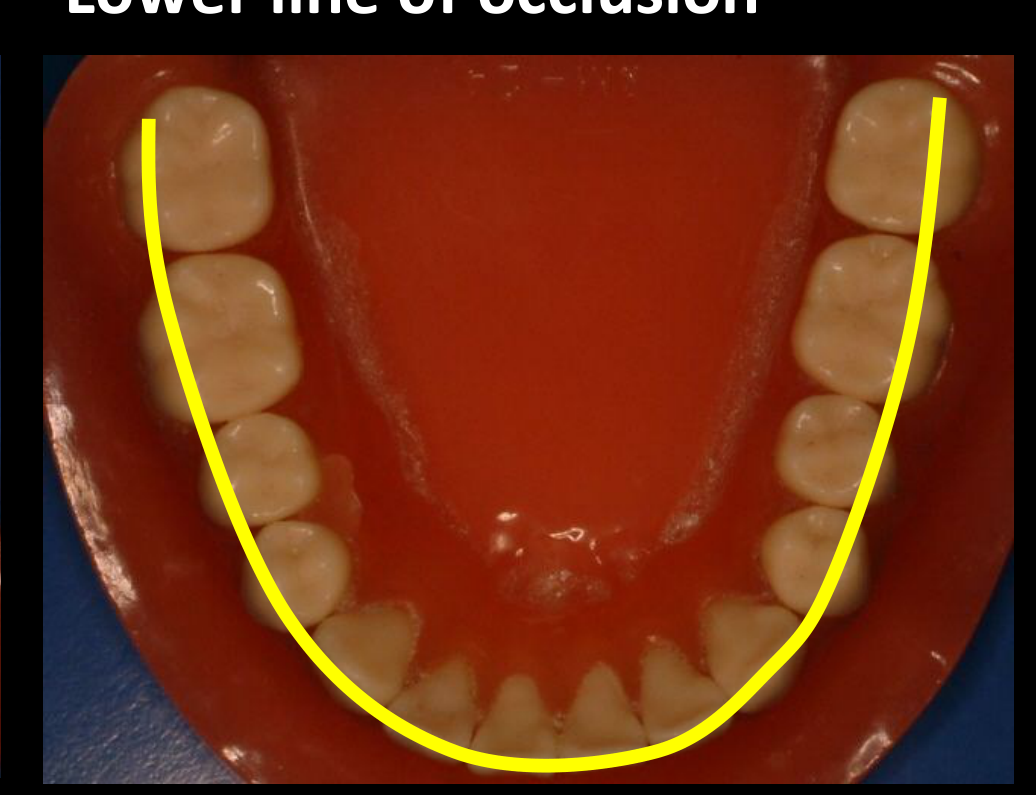 Lower line of occlusion