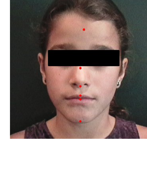 Facial Symmetry