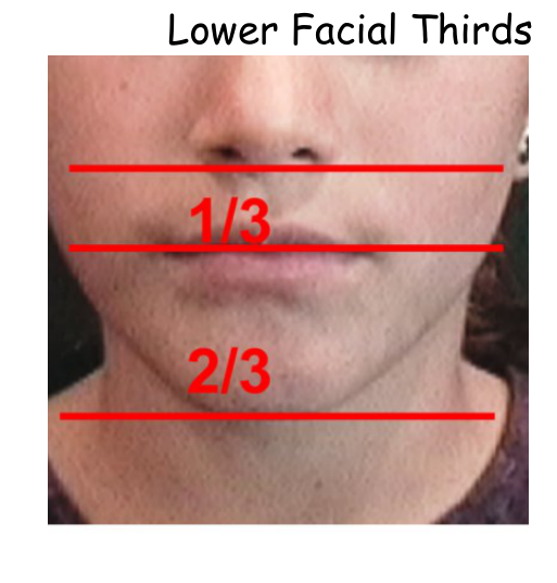 Lower Facial Thirds — Sn–Sto–Me marked and labelled 1/3 and 2/