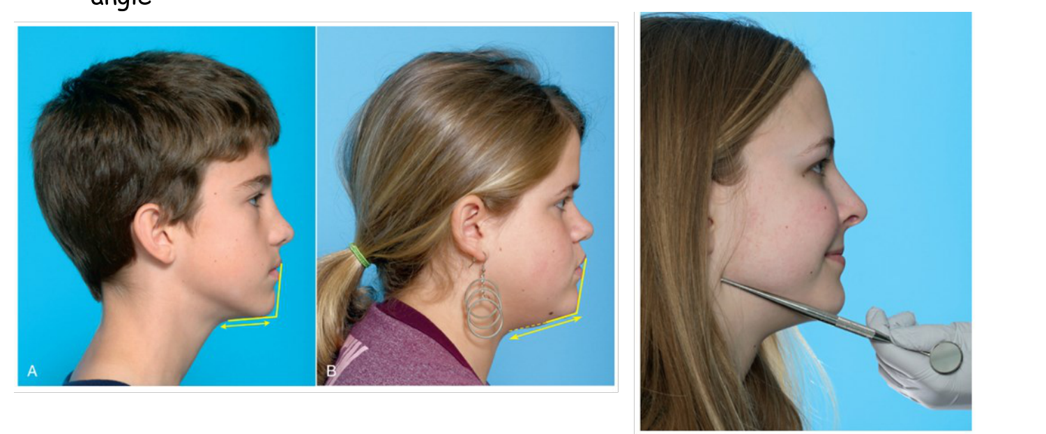 Mandibular plane angle drawn in yellow on two profiles, plus the mirror-handle technique