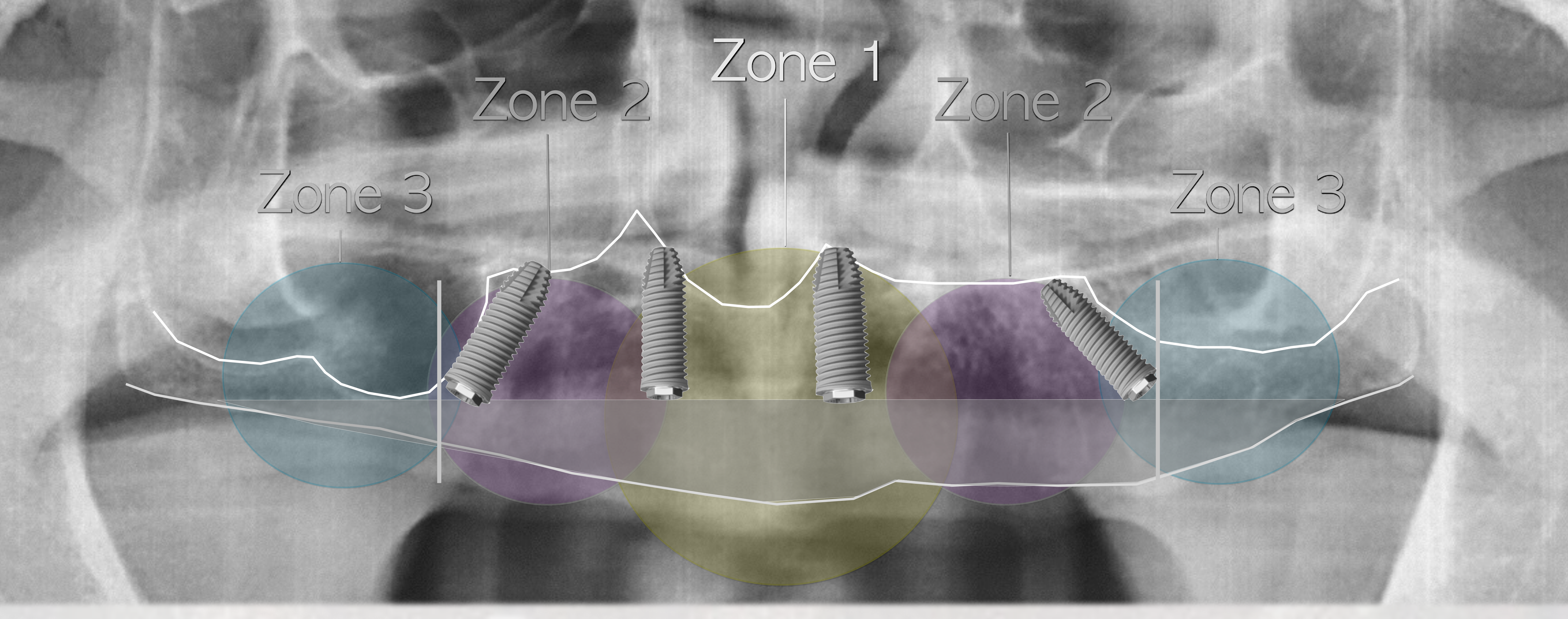 Bedrossian E, Sullivan RM, Fortin Y, Malo P, Indresano T. Fixed-prosthetic implant restoration of the edentulous maxilla: a systematic pretreatment evaluation method. J Oral Maxillofac Surg. 2008;66(1):112-22.