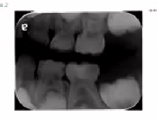 =<mark> Radiographic examination (bitewing) </mark>=