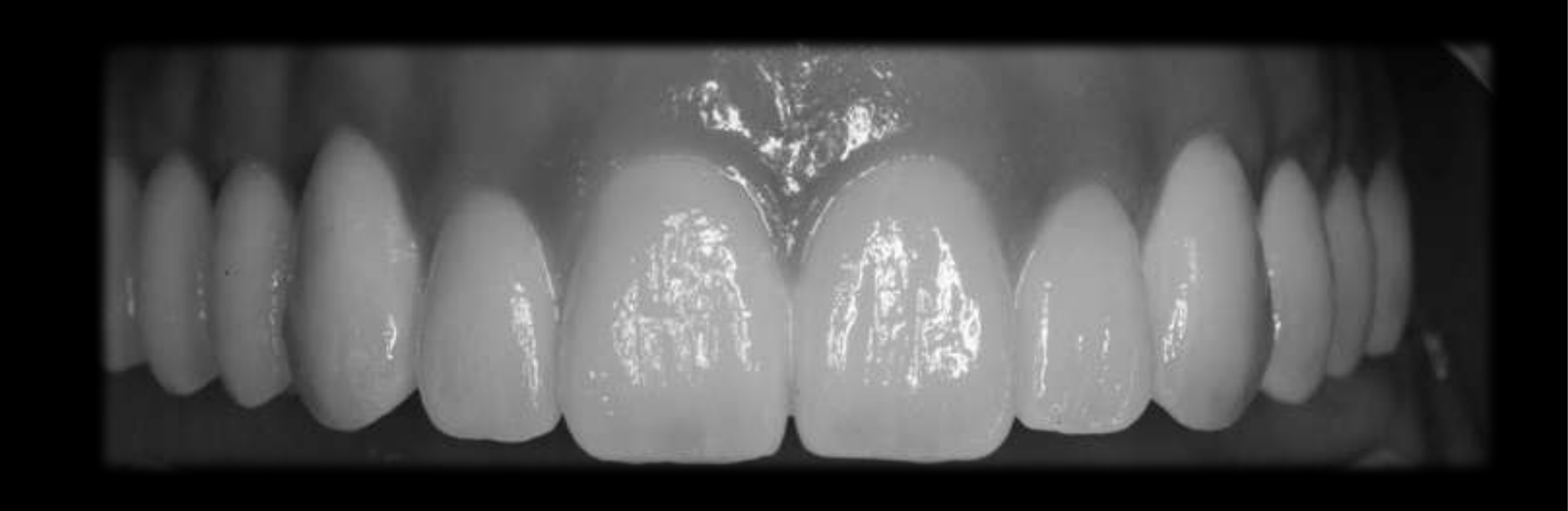 Need occlusal splint