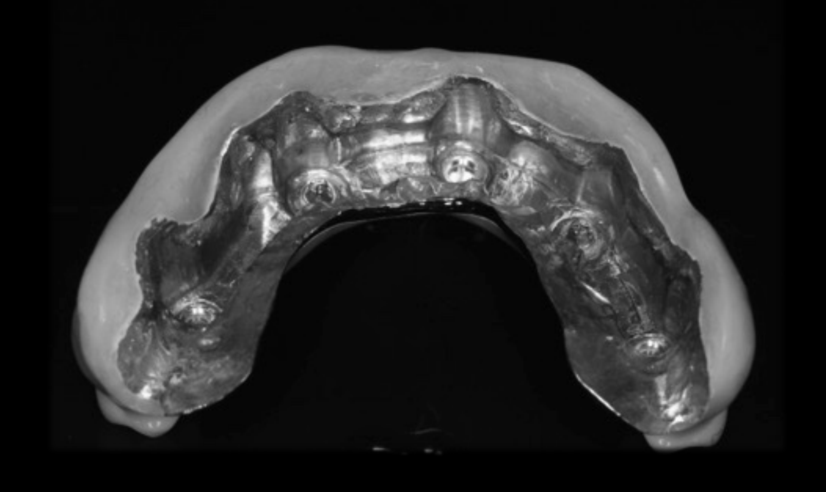 Implant Detachable Prosthesis