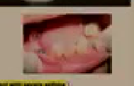Figure 1.25.1: Picture of caries / retained roots in a patient with severe asthma