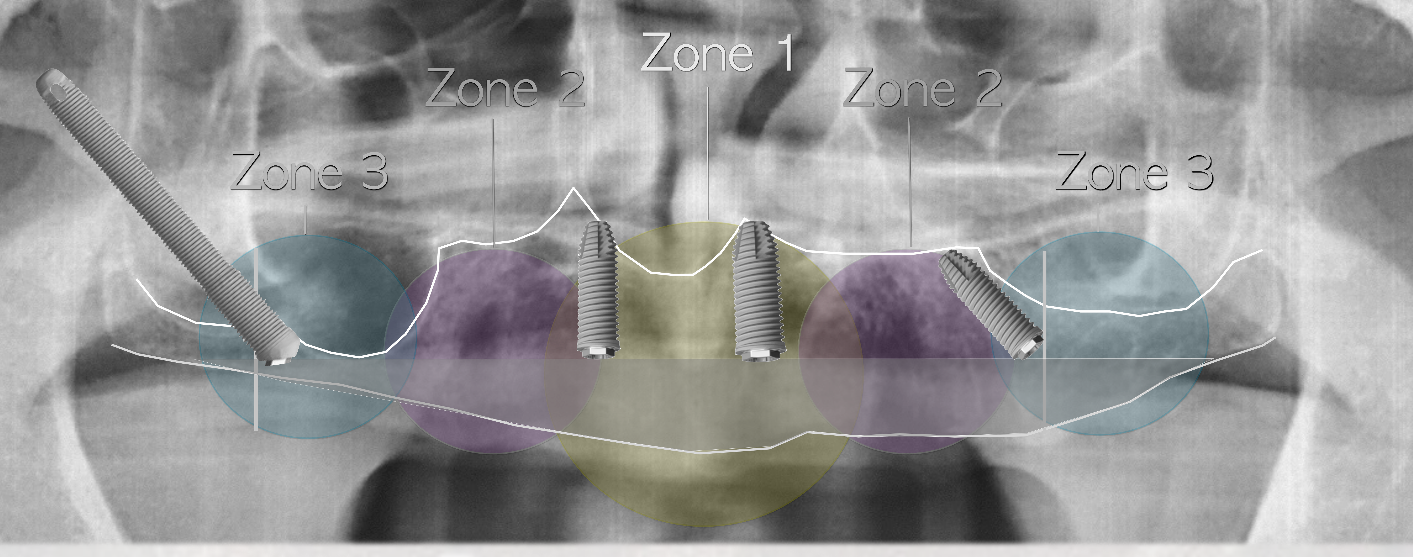 Ridge reduction affects implant length and AP spread