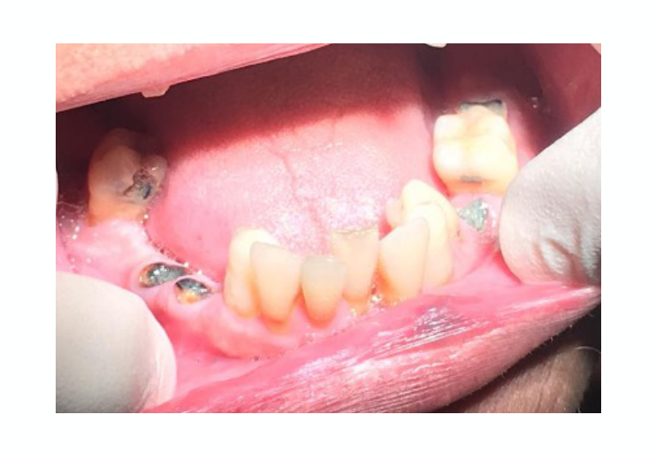 Figure 1.27.1- Picture of caries / retained roots in a patient with severe asthma