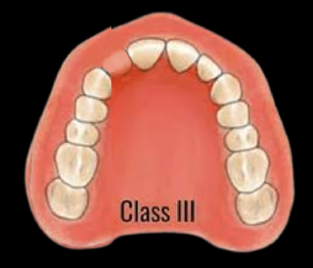 Class III