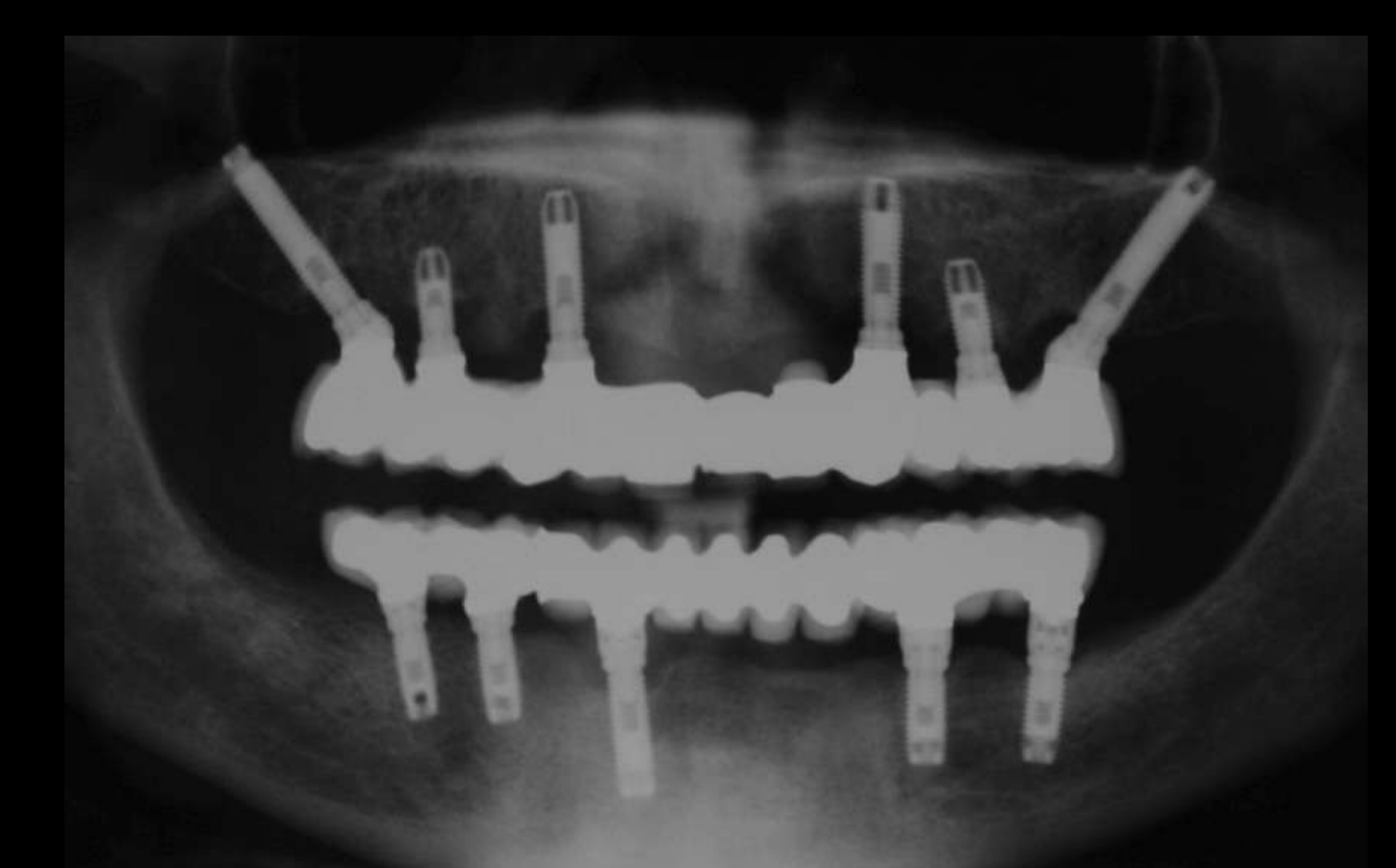 Superstructure cementation