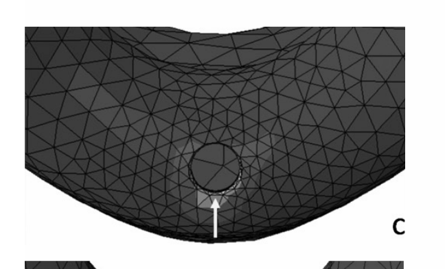 Single implant design