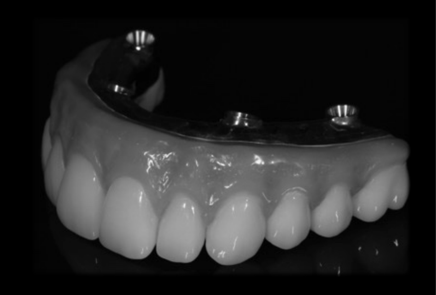 Fixed Prosthesis