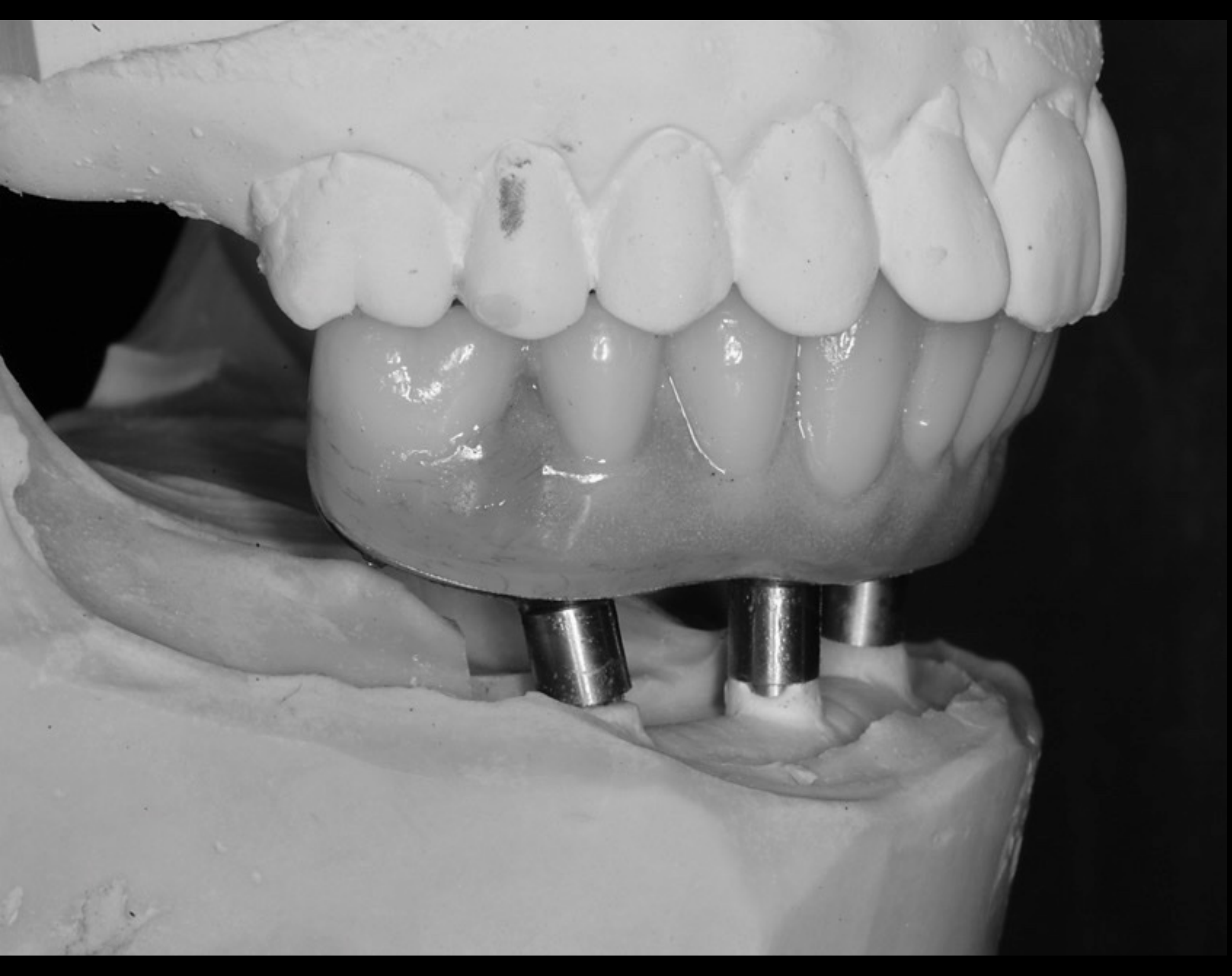 Definitive phase – 1yr after implant placement Procera Titanium/acrylic