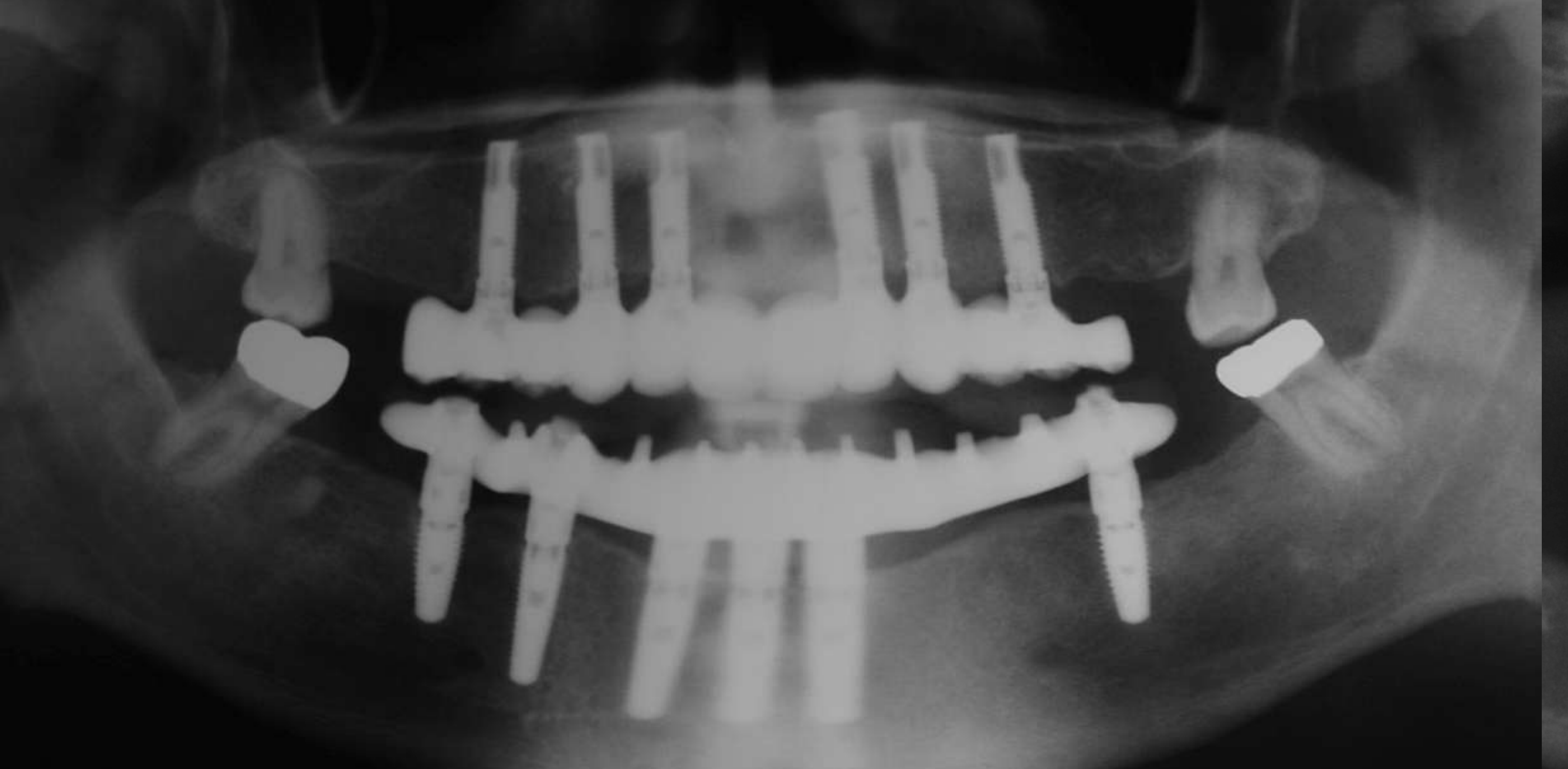 Axial implants no grafting