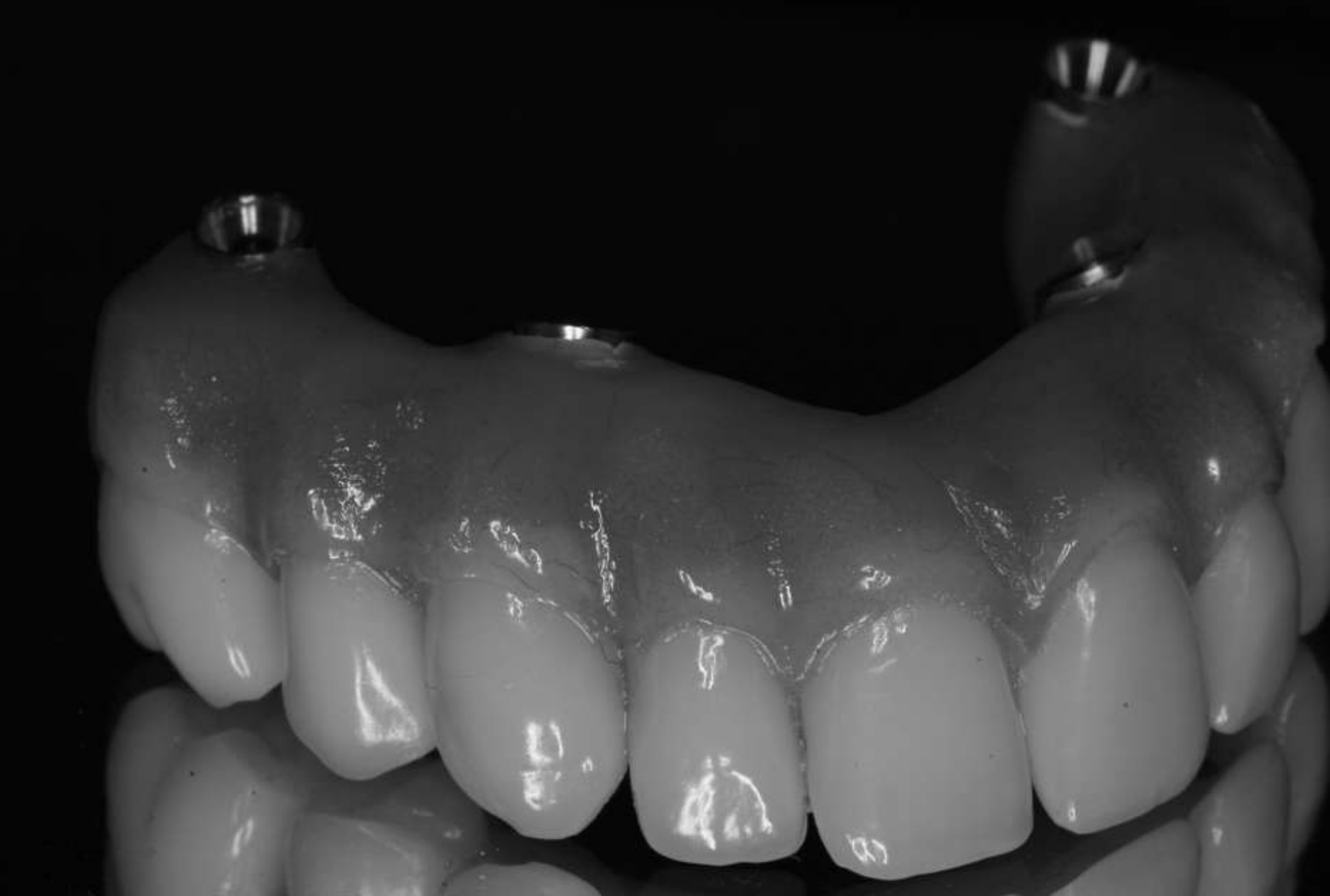 Rigid prosthesis