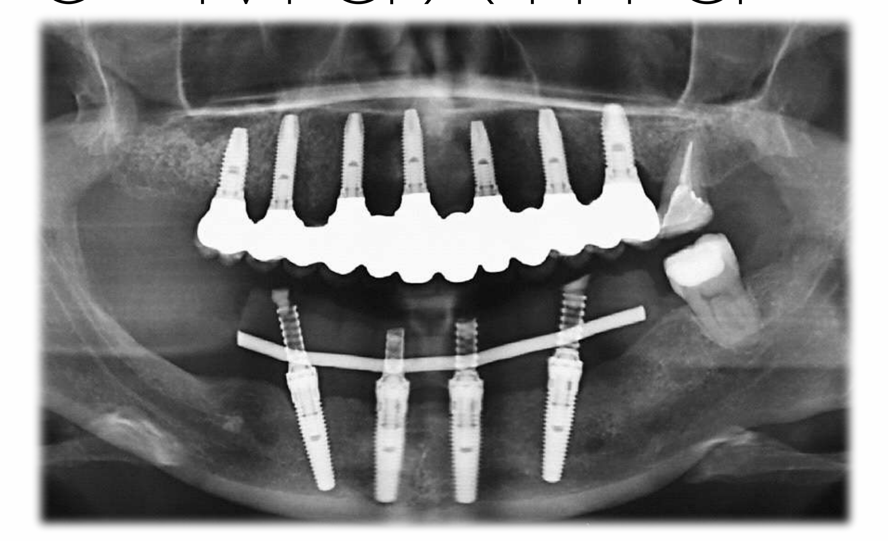 Augmentation