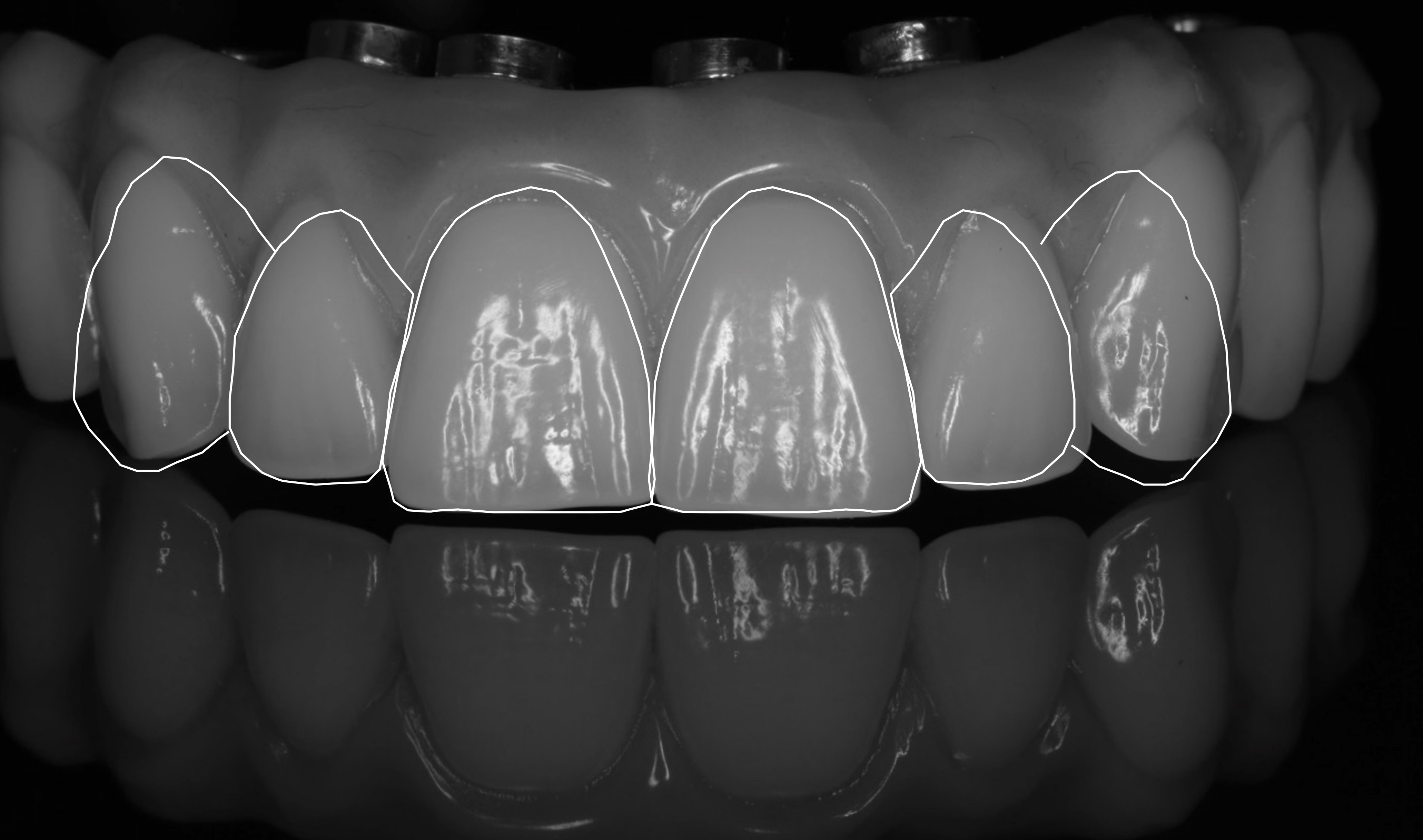 Fluorosis